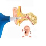 Kit de Retrait de Cire d’oreille Doctor’s Ear – Image 2